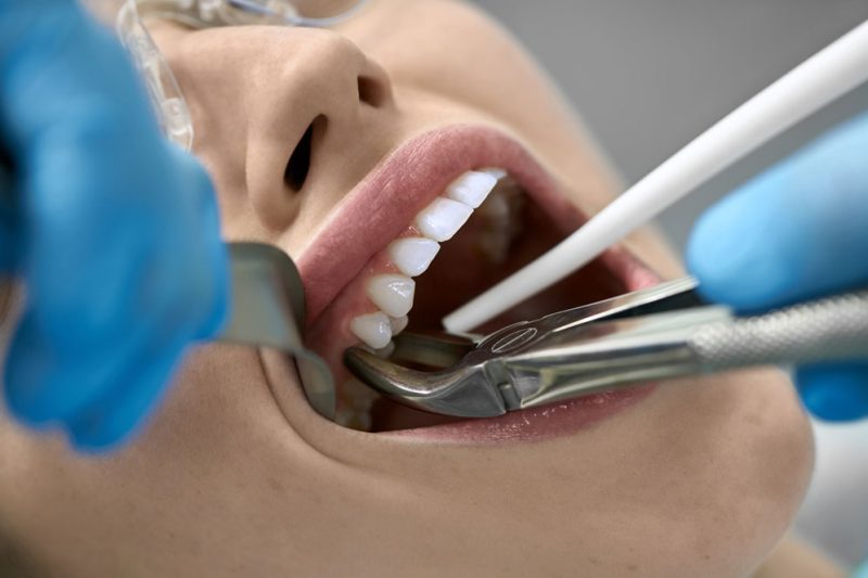 Specialist Surgical Extraction of teeth Accudental Clinica Dental