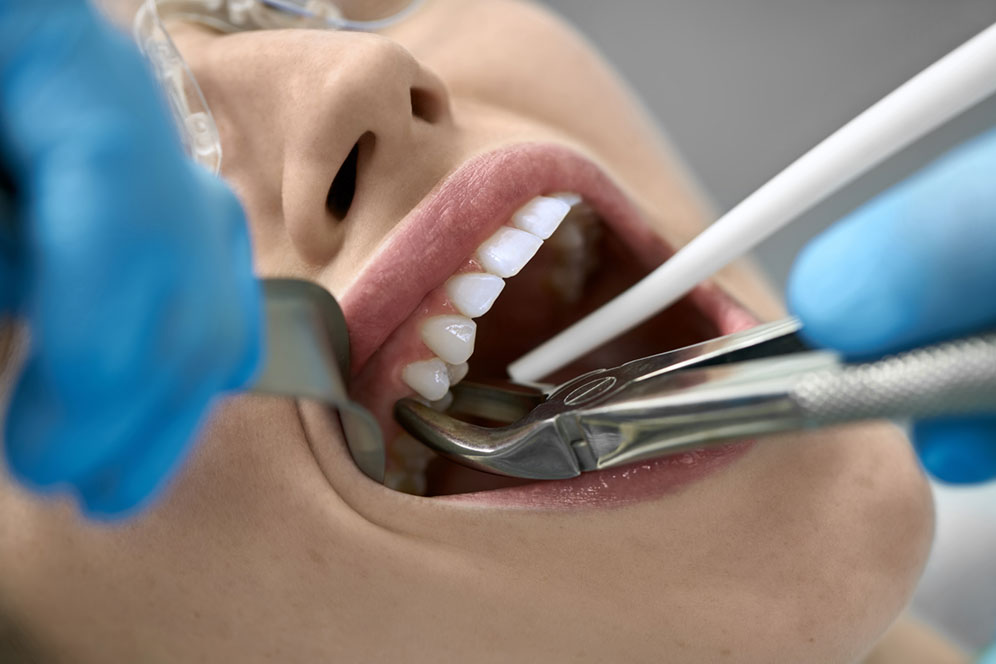 Specialist Surgical Extraction of teeth Accudental Clinica Dental